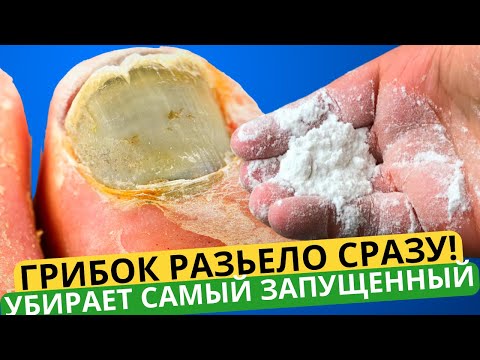 ГРИБКОВЫЙ НОГОТЬ СЛЕЗ, А НОВЫЙ Вырос! МОЩНЕЙШИЙ РЕЦЕПТ: ГРИБОК Ногтей ИСЧЕЗНЕТ НАВСЕГДА!