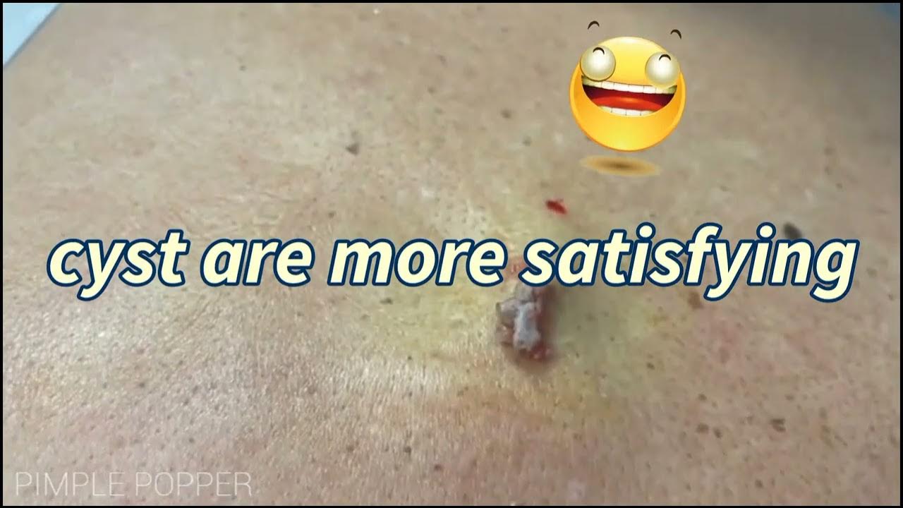 cyst squeeze removal YouTube