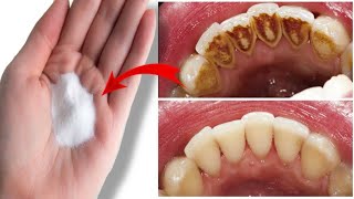 केवल 1 मीनट में गंदे पीले दात मोती जैसे चमक जाएंगे इस उपाय से | Teeth whitening remedy