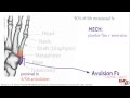 5th Metatarsal Fractures