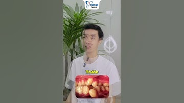 Thay đổi ngoạn mục của bạn Bảo Long sau khi niềng răng tại Nha khoa Tâm An