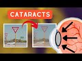 What CATARACTS do to your vision..
