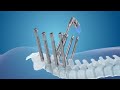Medtronic: CD Horizon Solera Voyager &amp; Artic-L 3D TI