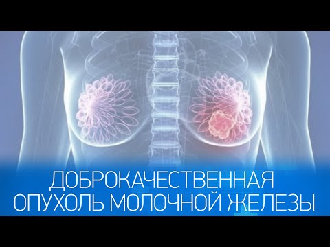 Доброкачественные новообразования молочной железы