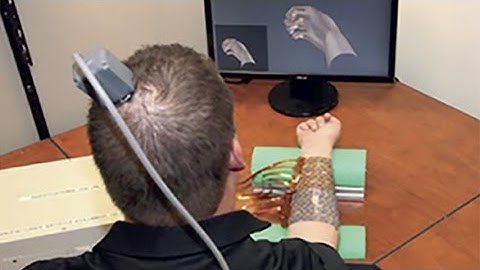 Neural bypass system restores movement in quadriplegic patient