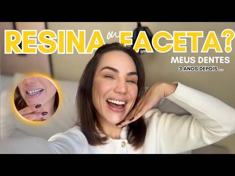 LENTES DE RESINA OU FACETA ? MINHA OPINIÃO SINCERA