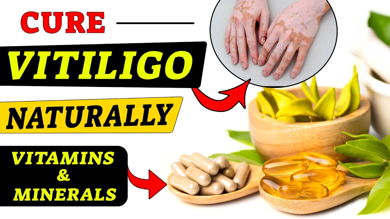 Cure Vitiligo Naturally Best Vitamins and Minerals For Vitiligo