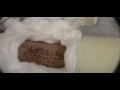 10 Days After Ruptured Achilles Tendon Surgery - Wound Video