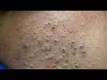 [ASMR] Korean Skincare Routine for Acne and Blackheads, Deep Cleansing Techniques