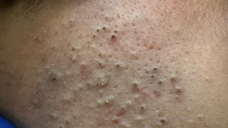 [ASMR] Korean Skincare Routine for Acne and Blackheads, Deep Cleansing Techniques