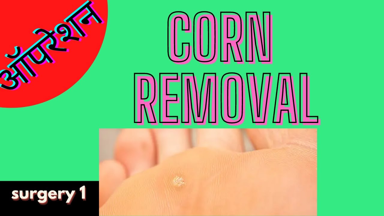 Corn removal surgery / corn excision procedure / टिक निकालने का ऑपरेशन