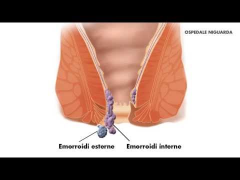 Emorroidectomia