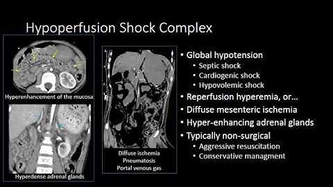 Small Bowell Ischemia