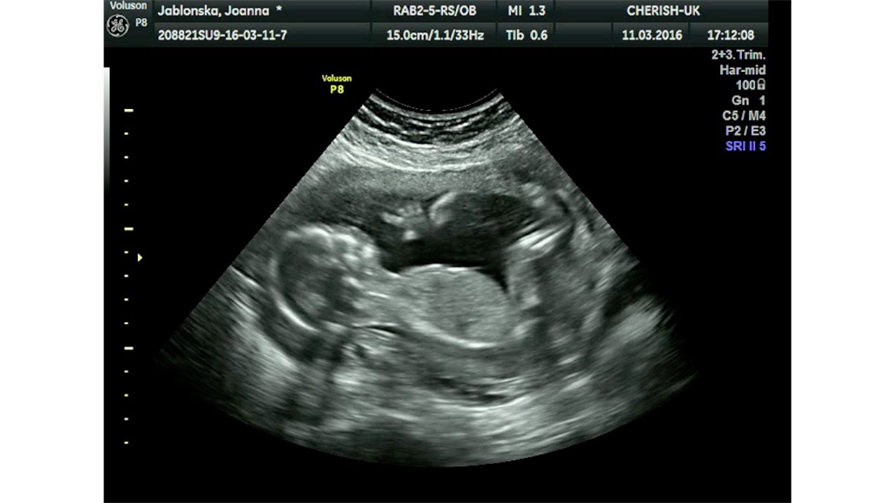 Baby Scan 16 3 2016 YouTube Baby Scan 16 3 2016 YouTube