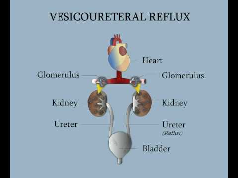 ვიდეო: შეიძლება თუ არა დაბრუნდეს ვეზიკოურეთერალური რეფლუქსი ოპერაციის შემდეგ?