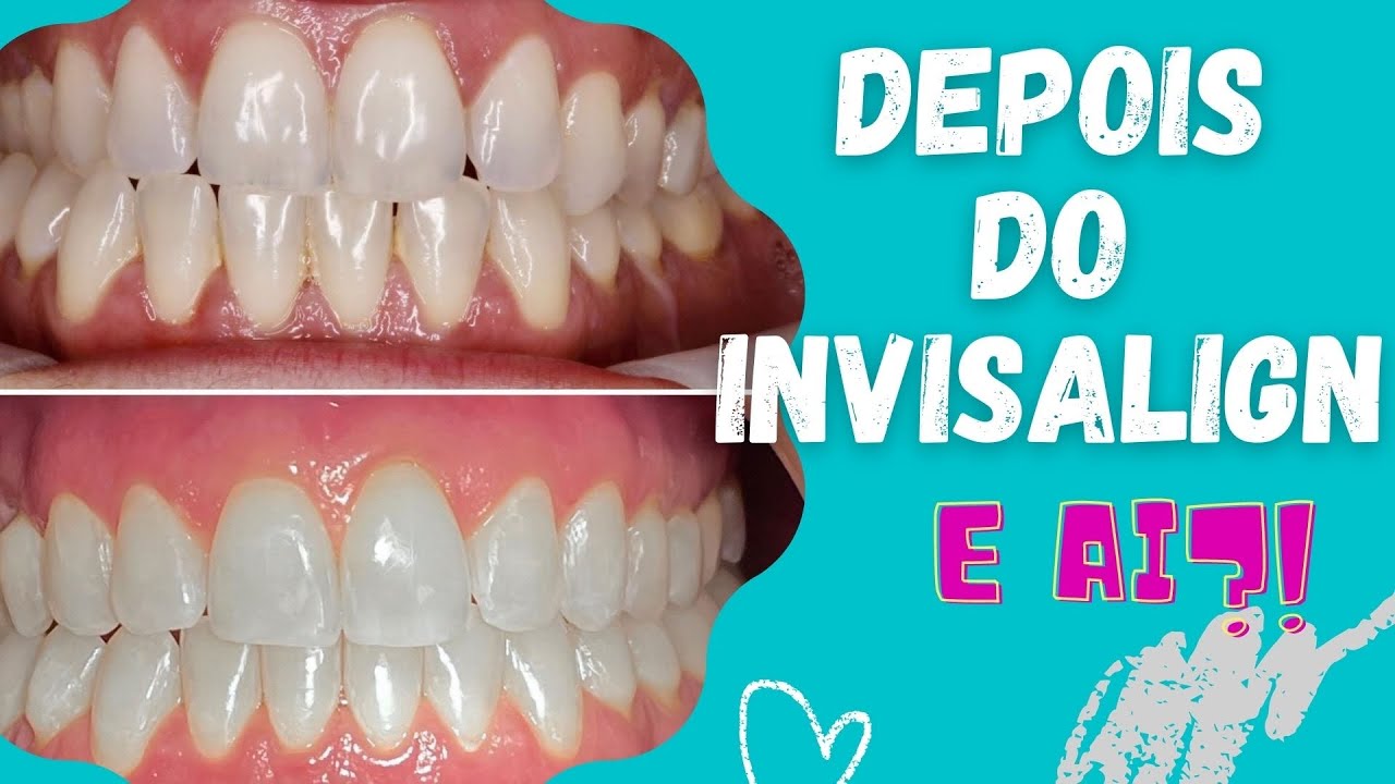 Depois do Invisalign… e agora? 