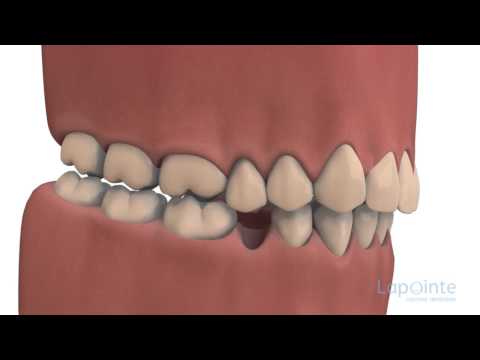 Vidéo: Les dents du haut et du bas doivent-elles se toucher ?