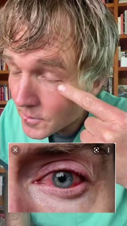 Natural Remedy for Demodex Mange