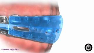 Sports Mouthguard (Braces Friendly) Wealth