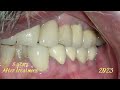 Dental Implant Result: From 2015 To 2023
