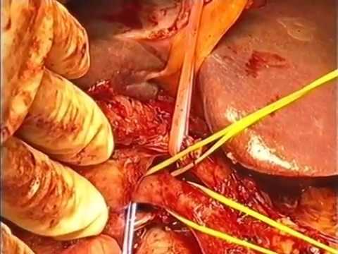 Left Hepatopancreatoduodenectomy