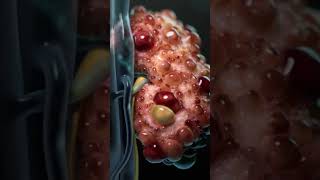 Polycystic Kidney Disease Explained! 🫘😲 #healthcare #medicalshorts #anatomy