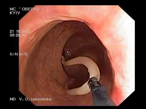 Ascaridosis on colonoscopy. Аскариды при колоноскопии