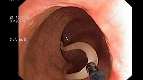 Ascaridosis on colonoscopy. Аскариды при колоноскопии