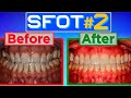 Sfot part 2  invisalign progress update ambitious expansion plans  unexpected benefits from sfot