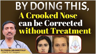 How to Treat Deviated Nasal Septum at Home | Correction of a Crooked Nose | | Socialpost Healthcare
