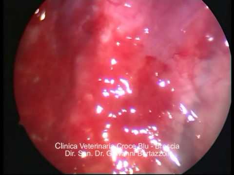 2)PIOTORACE - BIOPSIA PLEURICA.mpg