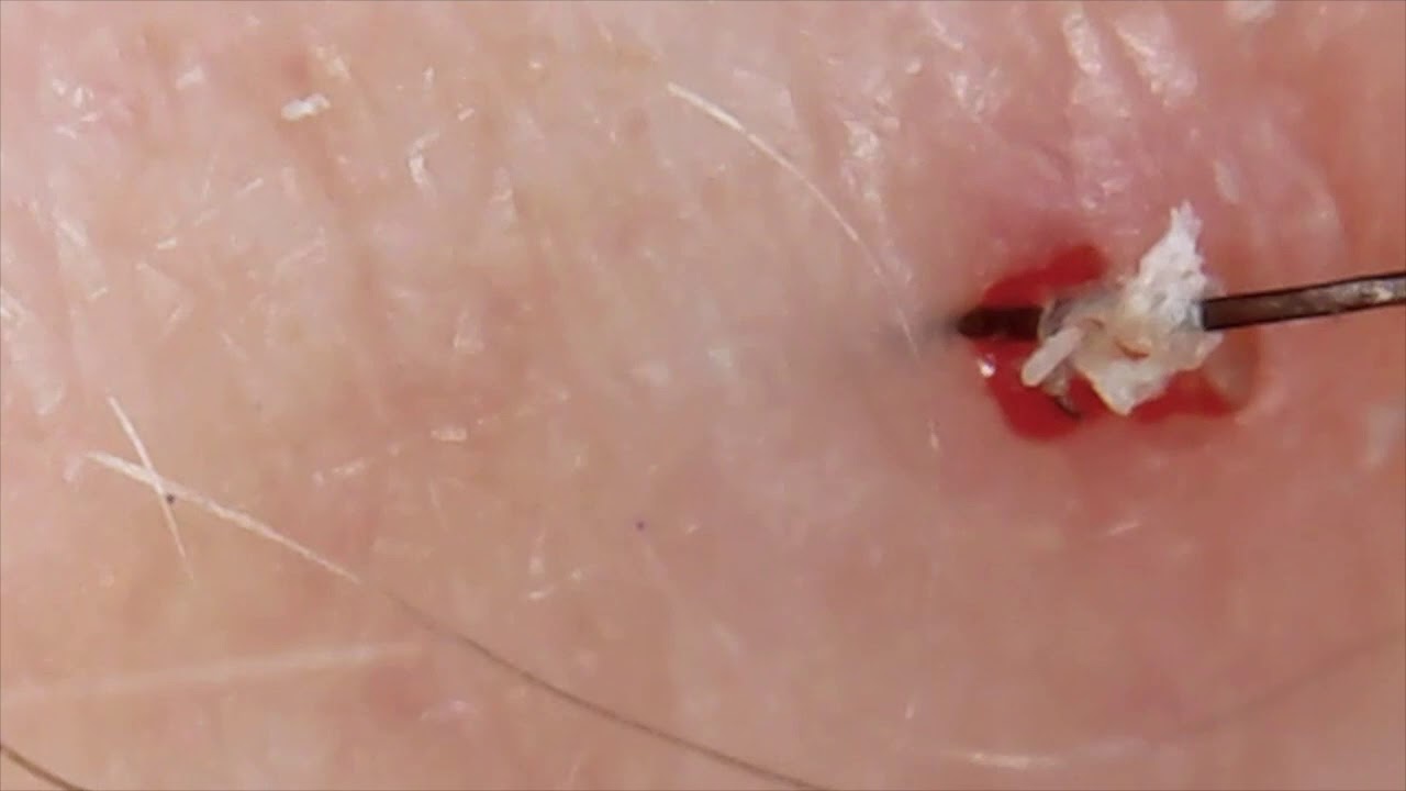 Ingrown Hair Removal Under The Microscope Youtube