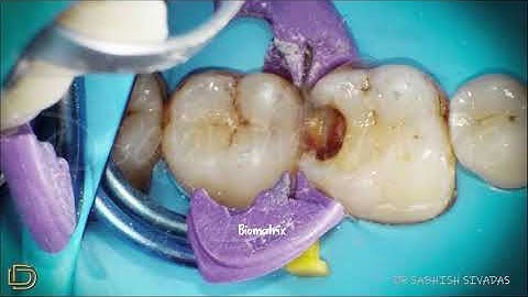 Class II restoration by Injection moulding