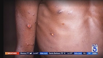 World Health Organization declares monkeypox a global emergency