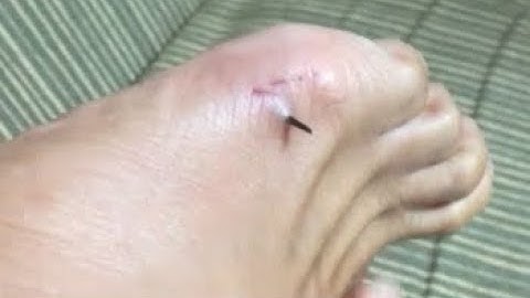 Satisfying Splinter Removal Video - big splinter in foot