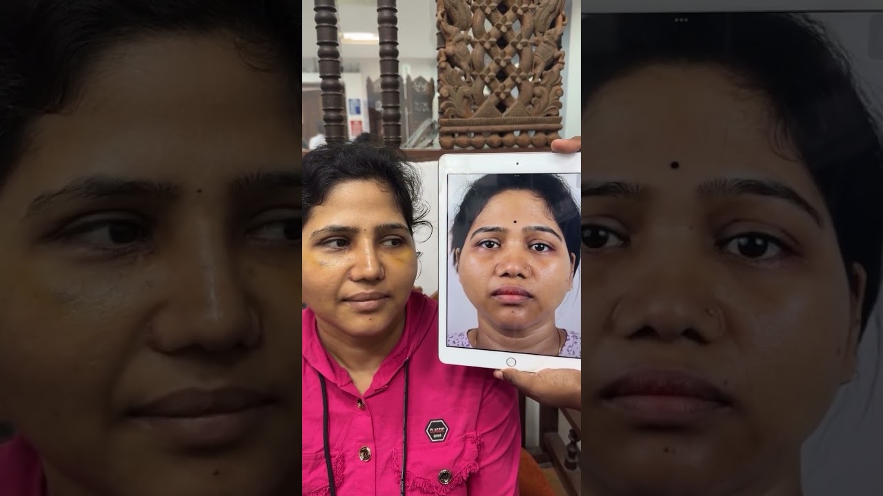 Rhinoplasty Before & After