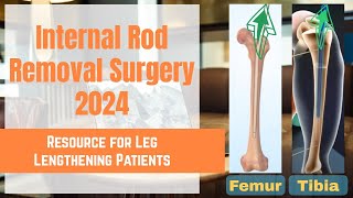 Internal Rod Removal Surgery Process for Limb Lengthening Patients - Updated 2024 by Height Journey