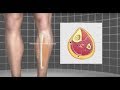 Runner's Compartment Syndrome - Mayo Clinic