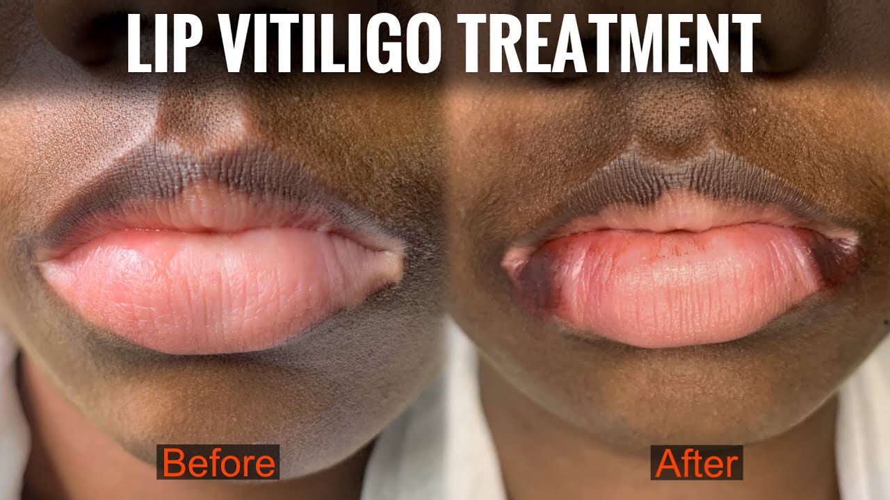 Lip vitiligo treatment 100 results No side effects machu tattoo