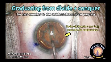 CataractCoach 1537: are you ready to graduate from divide conquer?