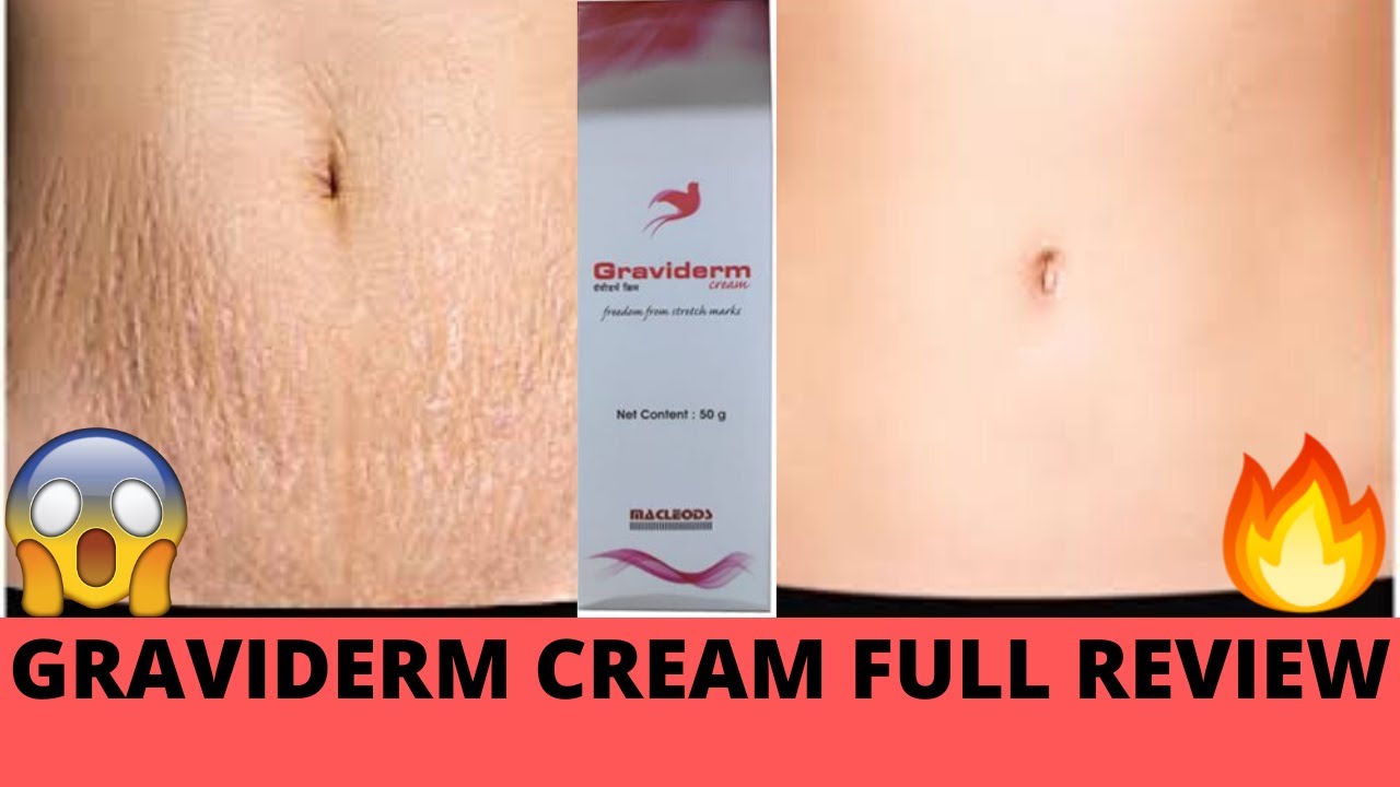 stretch marks hatane ke liye cream