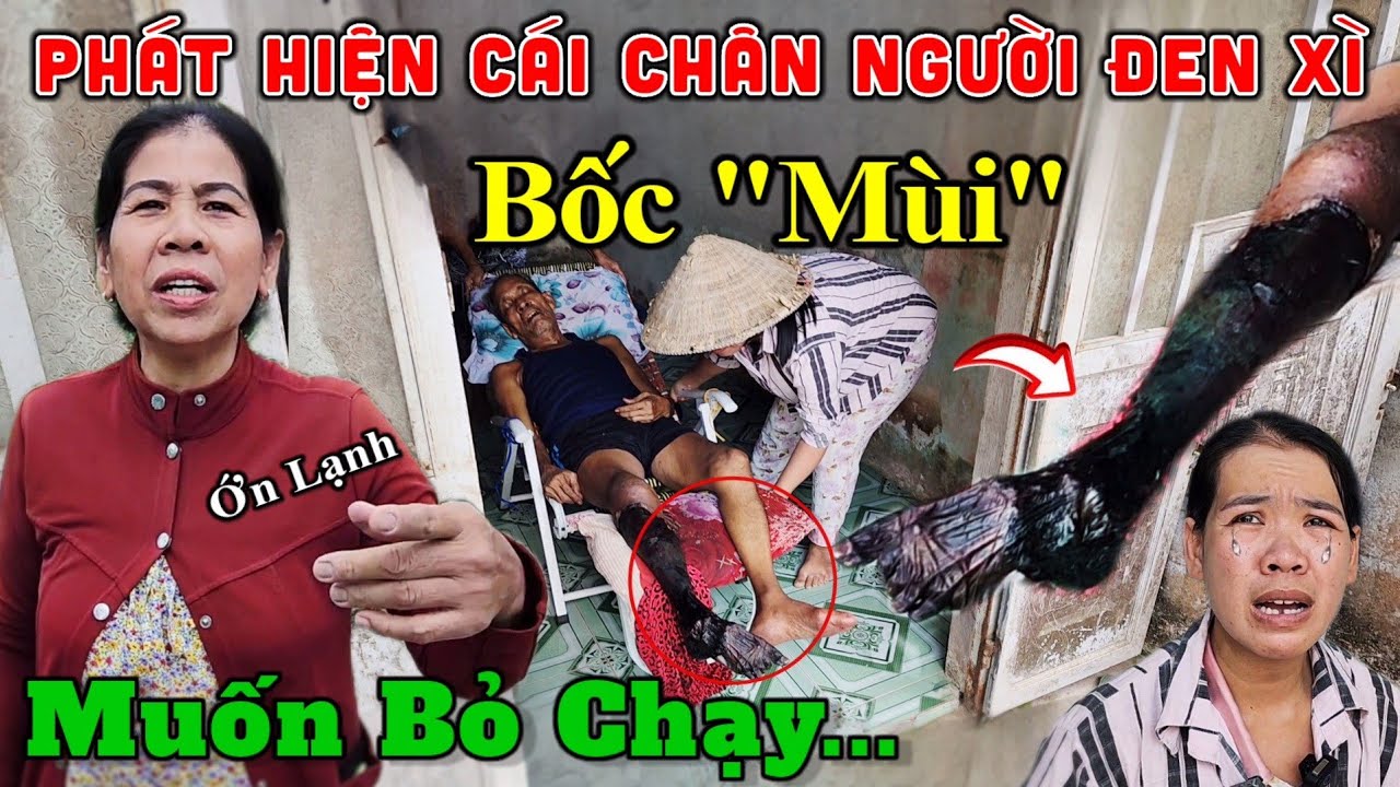 Khẩn Cấp Cái Chân Đen Xì, Ông Chú Mắc Bệnh Lạ Không Tiền Đi Viện