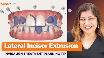 Lateral incisor extrusion with Invisalign: Best attachment design and tips - evidence and experience