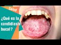 ¿Qué es la candidiasis bucal? | Salud