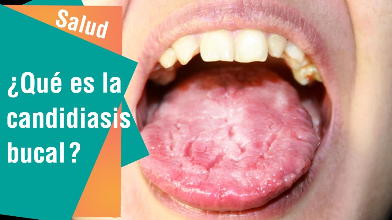 Qu Es La Candidiasis Bucal Salud YouTube