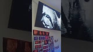 ECOGRAFIA de 11 semanas 1 dia  mamãe  estou bem.já ficando famosa (o)