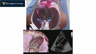 The Use of Augmented Reality in Ultrasound Education