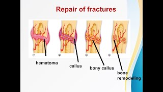 Fracture healing