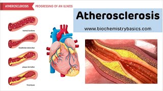 Atherosclerosis - Risk factors, Pathophysiology and Prevention