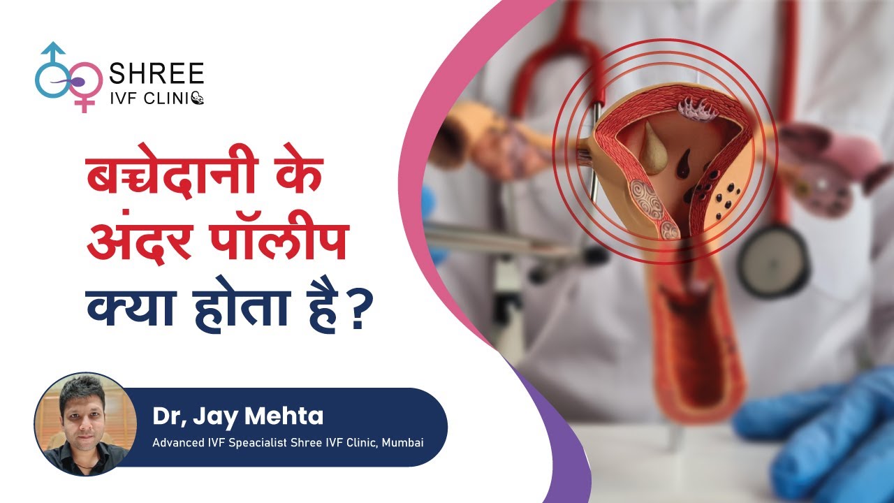बच्चेदानी के अंदर पॉलीप क्या होता है ? Endometrial Polyp In Hindi